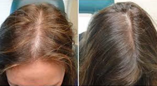 طرق علاج تساقط الشعر للنساء